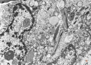 bone marrow - crystalloid inclusions Charcot-Leyden crystals formation bone marrow - crystalloid inclusions Charcot-Leyden crystals formation